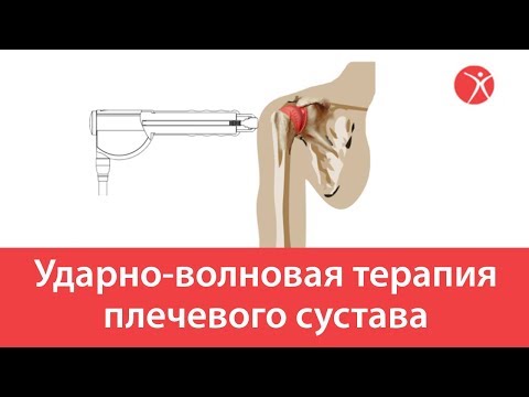 Ударно-волновая терапия плечевого сустава в клинике Стопартроз