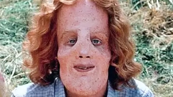 Mask - Heartbreaking Tragedy Of Rocky Dennis From "Mask" - YouTube