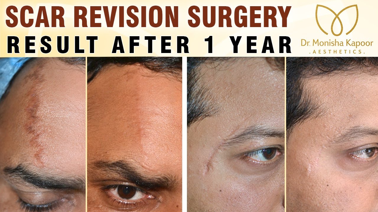 Scar Revision Surgery Permanent Scar Removal in India YouTube