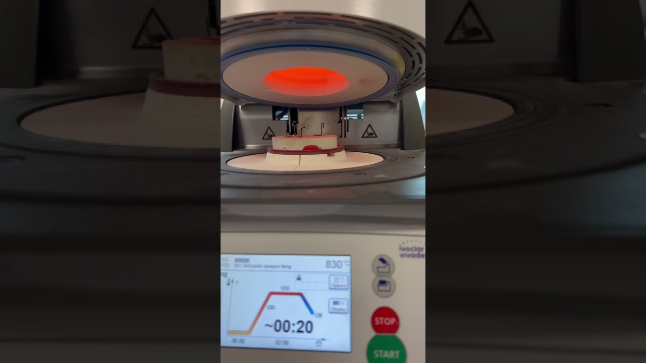 Ceramic crown firing in a furnace/dentine firing/incisal firing 