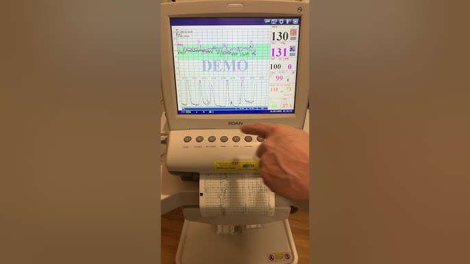 Edan X10 Patient Monitor - Sedation Resource