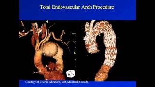 STS University Course 2: TEVAR and Aortic Arch Debranching Procedures