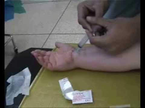 Steroid shots for carpal tunnel syndrome