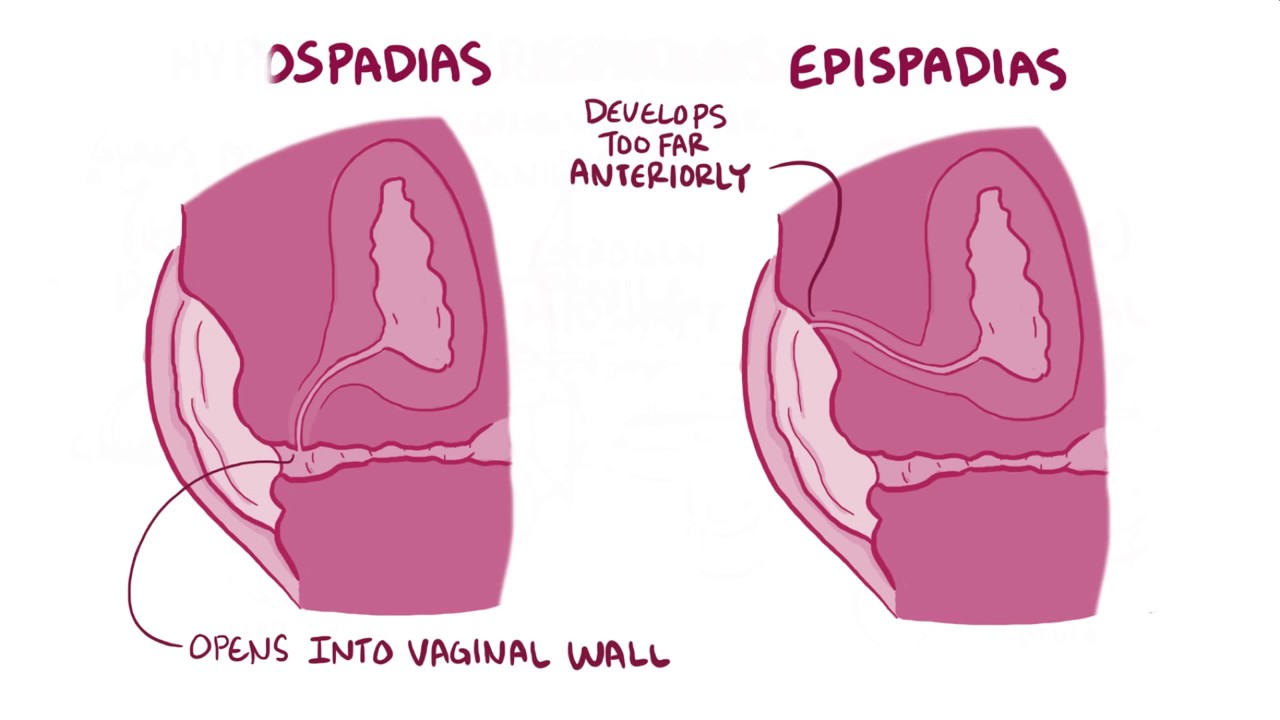 Hypospadias and Epispadias; Nursing Assessment, Diagnosis, and Interventions for Hypospadias and Epispadias; and 4 Nursing Care Plan Examples for Hypospadias and Epispadias.