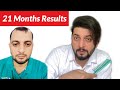 My hair transplant results after 21 months  cost  my hair transplant journey