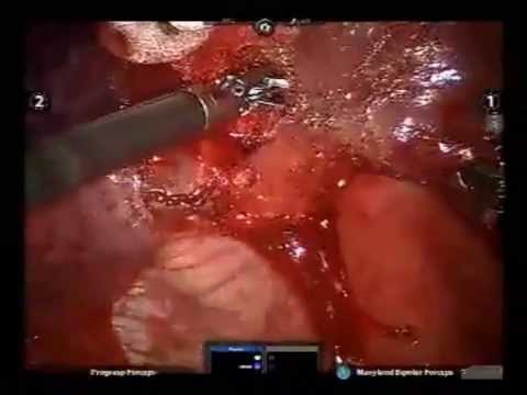 Robotic Left Lower Lobe Common Basal Segmentectomy For Echinococcus Alveolaris