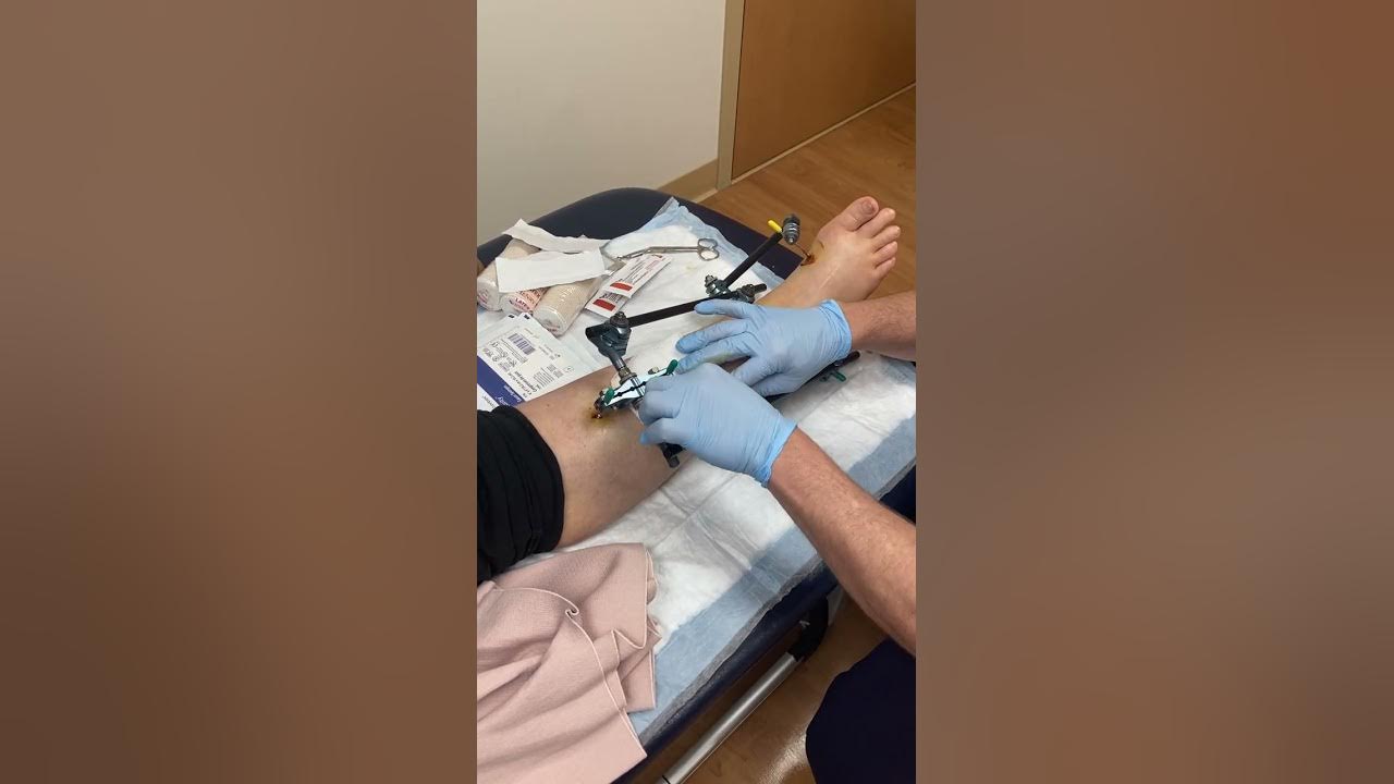 External Fixator Pin Site Care Dr Stewart M Kerr YouTube external-fixator-pin-site-care-dr-stewart-m-kerr-youtube