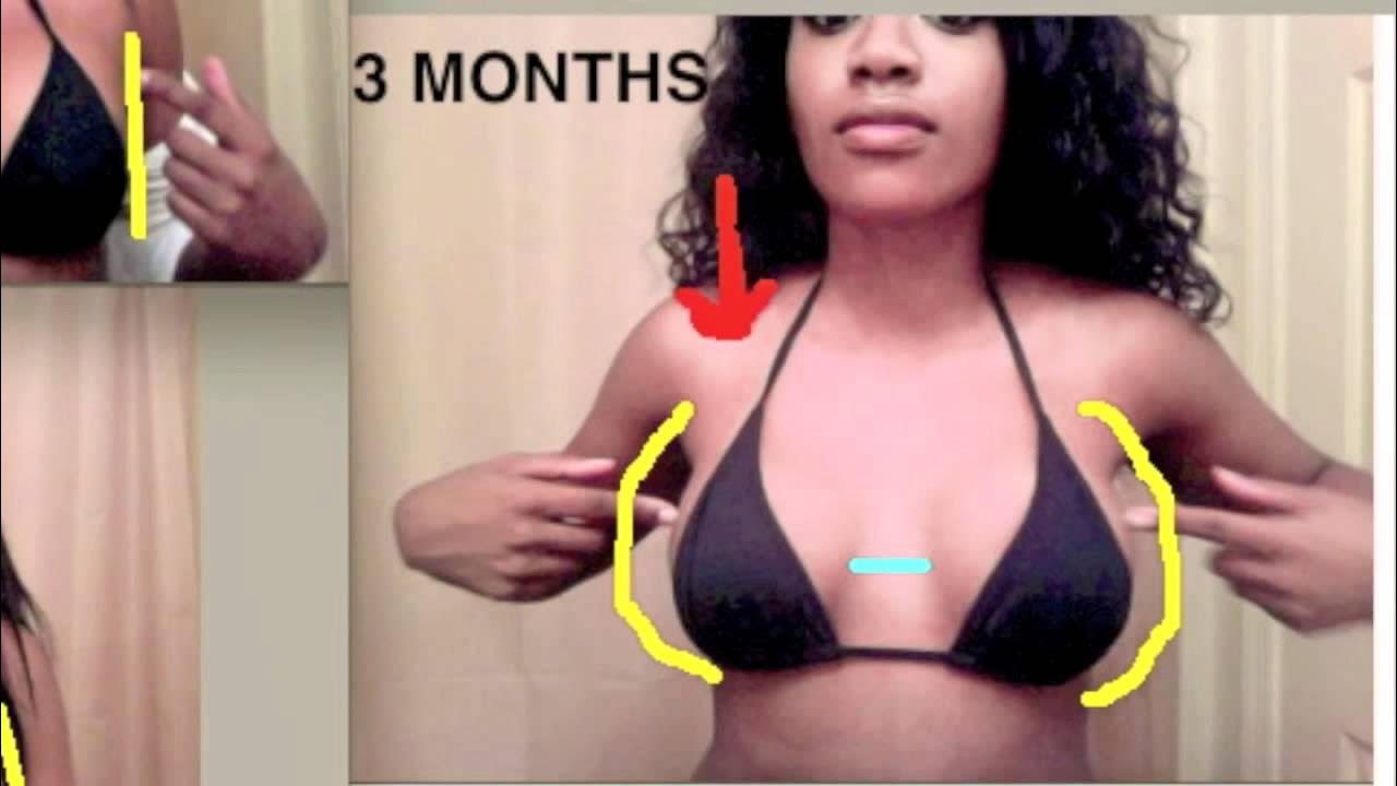 Breast Implants Before And After Progression Youtube