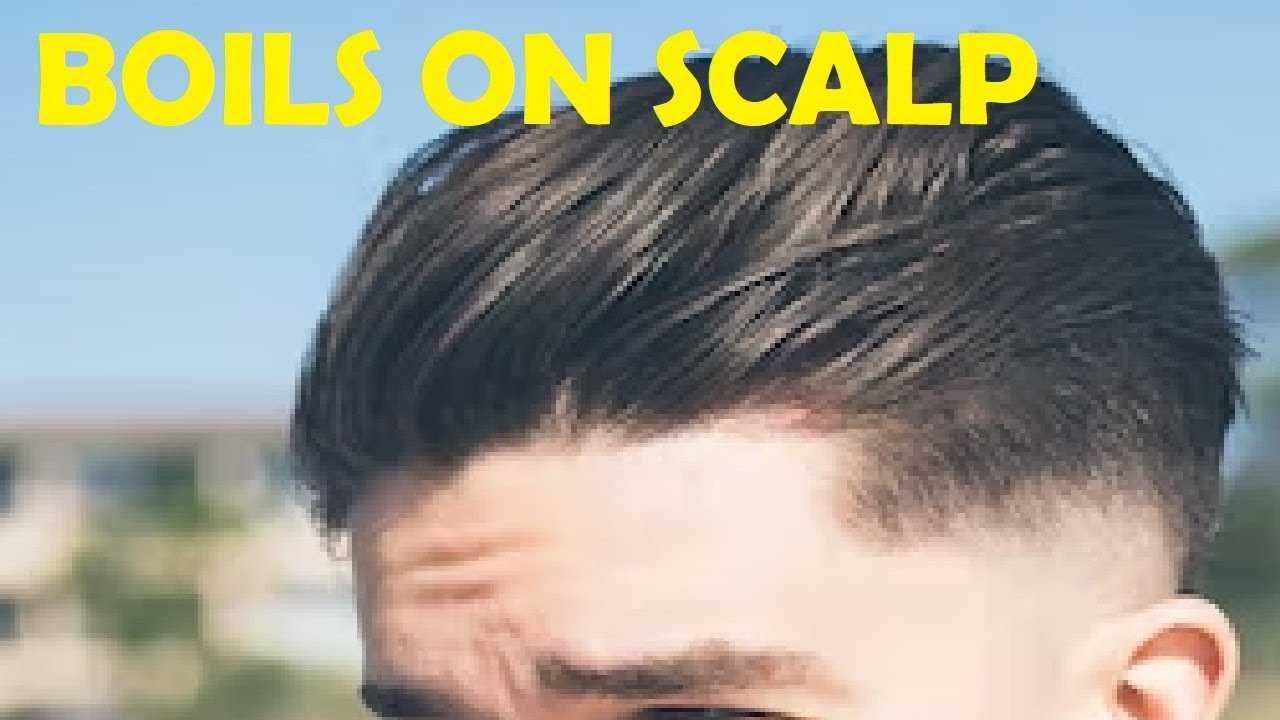 how to get rid of boils on scalp fast YouTube