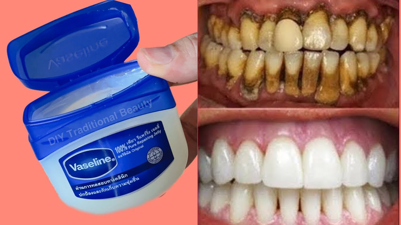 Teeth Whitening At Home In 3 Minutes With Vaseline How To Whiten