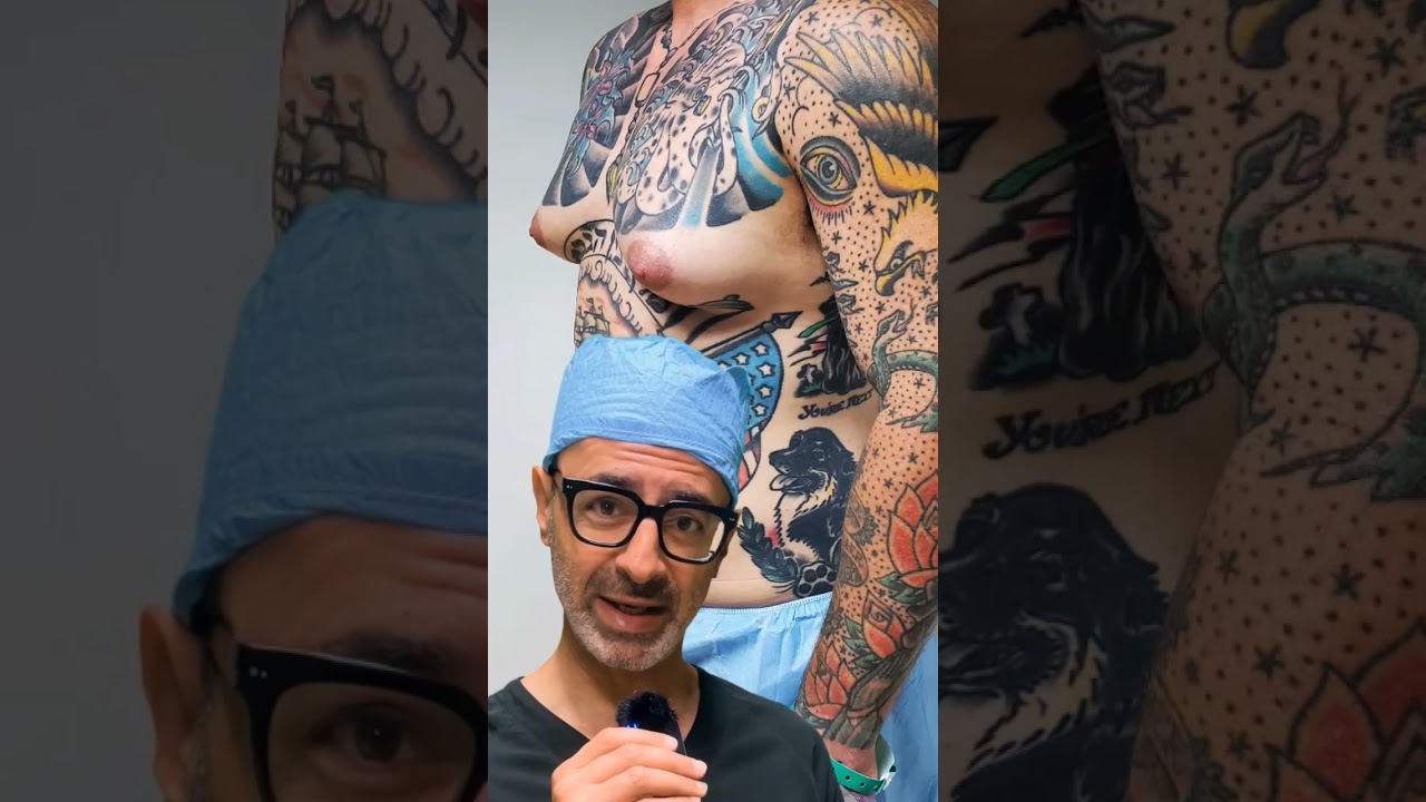 Grade 3 Gyno Transformation! 💪 This patient had severe gynecomastia caused by steroids. #beforeafter