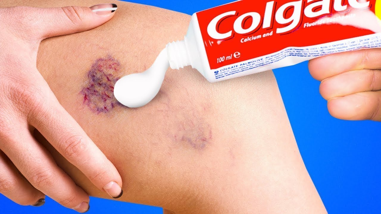 moreton y hematoma es lo mismo