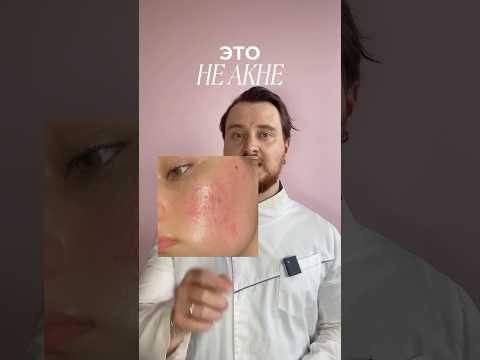 Как лечить розацеа в 2025 году?🤔 Подробнее читайте в комментариях!