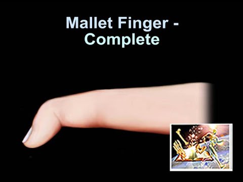 Mallet Finger Complete - Everything You Need To Know - Dr. Nabil Ebraheim
