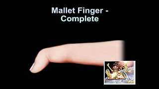 Mallet Finger Complete - Everything You Need To Know - Dr. Nabil Ebraheim