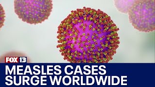 Measles cases surge worldwide | FOX 13 Seattle Profile