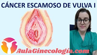 CÁNCER ESCAMOSO DE VULVA I: SÍNTOMAS, TIPOS, DIAGNÓSTICO y ESTADIAJE. - Ginecología y Obstetricia-