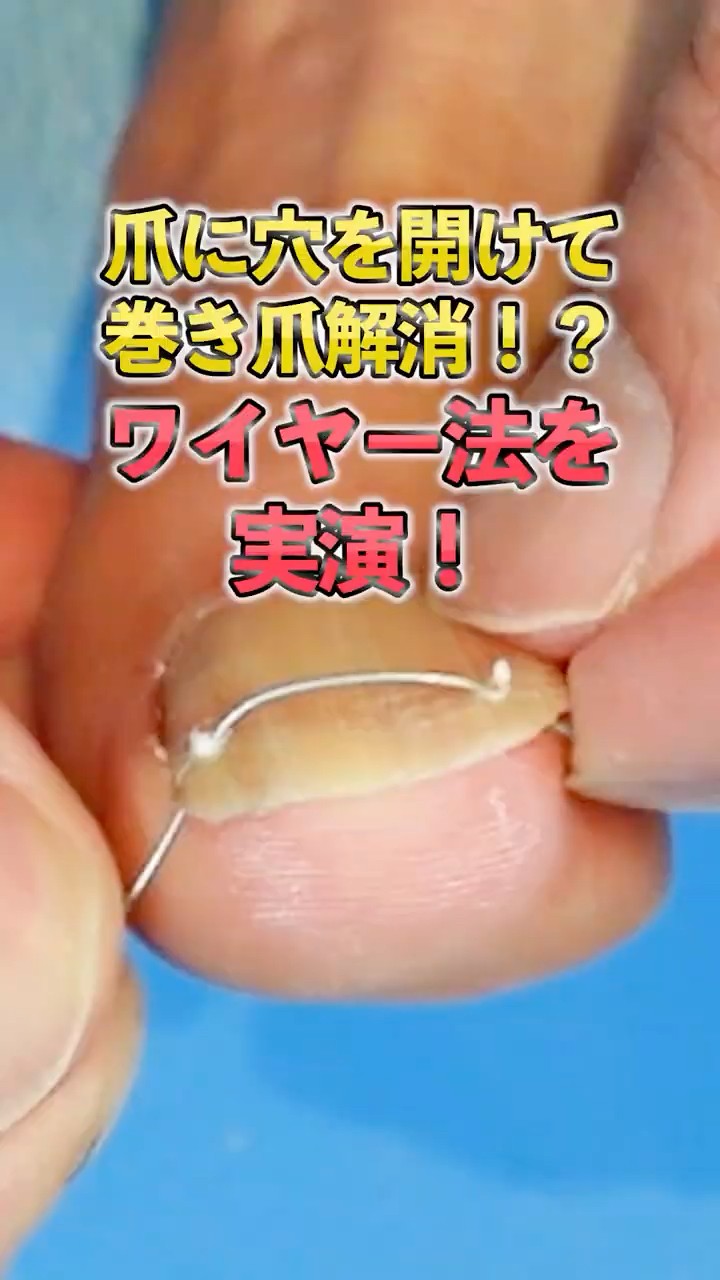 皮膚科 巻き 爪 矯正 自分 で 陥入爪