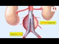Эндолики при стентировании аневризм аорты: типы и механизмы формирования при эндопротезировании