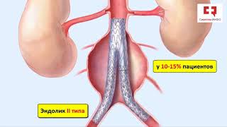 Эндолики при стентировании аневризм аорты: типы и механизмы формирования при эндопротезировании