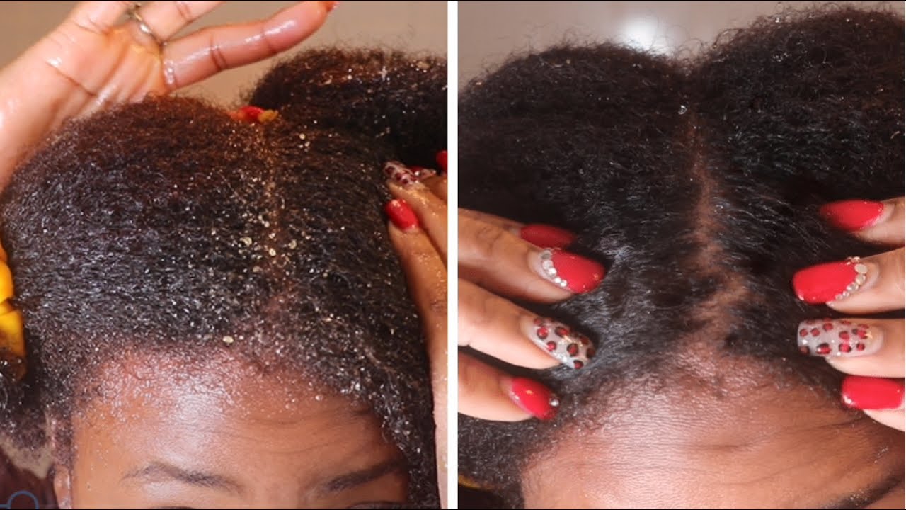How to Sugar Scalp Scrub and Tea Remove Buildup for healthy hair
