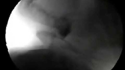 Video 2 - Grossly abnormal swallowing in an infant. (Severe pharyngeal phase dysphagia.)