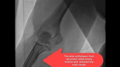 radial recurrent artery