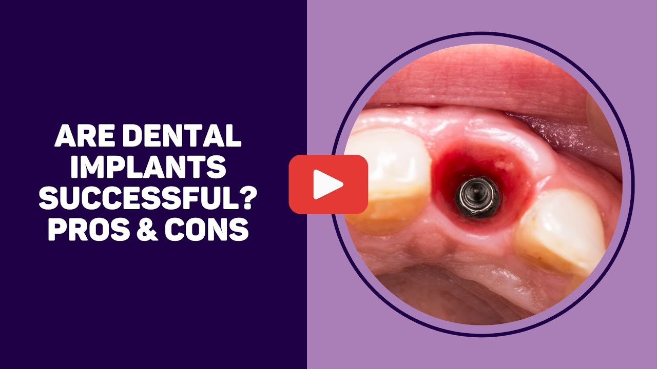 Are dental implants successful? Pros & Cons