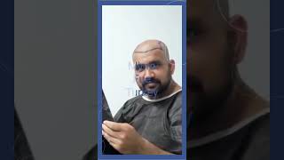 Hair Transplant Clinic Turkey