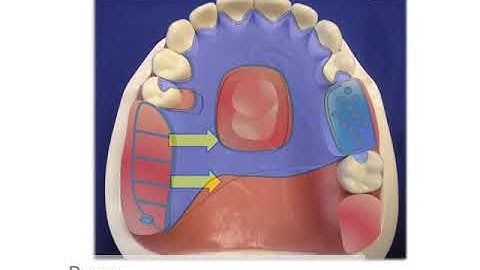 Maxillary Kennedy Class Two Mod 1 Design Scenario