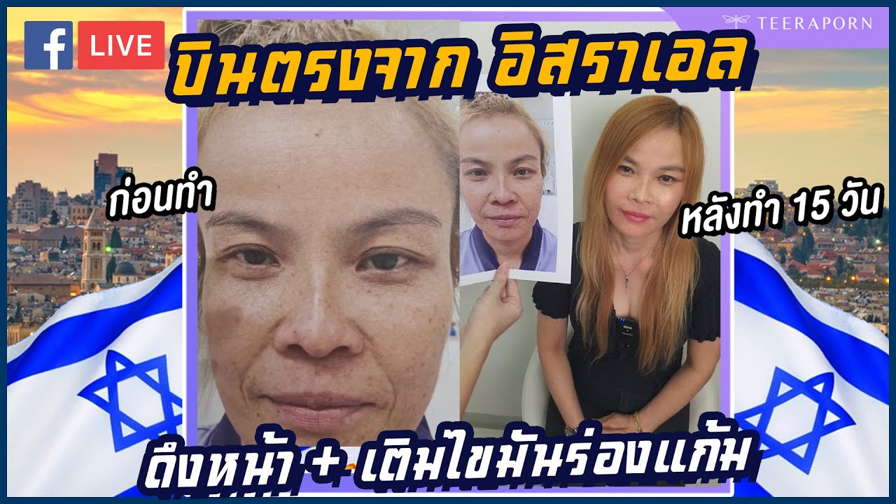 บินตรงจากอิสราเอล เพื่อมาดึงหน้าfacelock +เติมไขมันร่องแก้ม วันนี้ครบ 15วัน