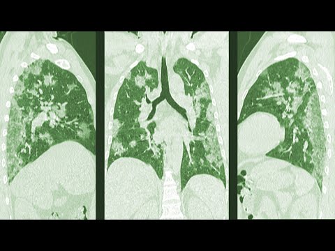 3 COVID-19 Cases As Described By Doctors In China