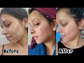 HOW I CLEARED MY ACNE | My Acne to Clear Skin Journey with Pictures | Products/Treatment?