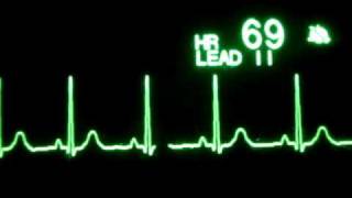 Normal Sinus Rhythm