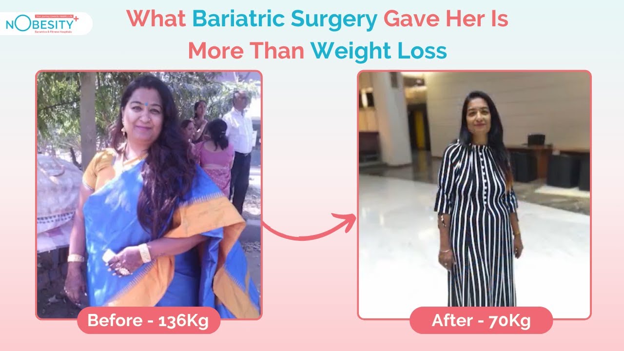 Mrs. Neha Mehta’s Weight Loss Journey: Bariatric Surgery in Ahmedabad, India - NObesity