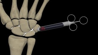 Wrist injections & wrist arthrography