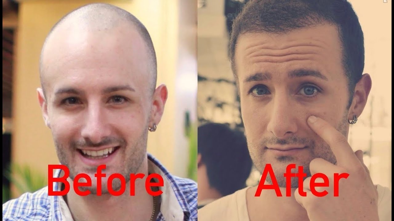 ANSWERED The Earliest You Can Have A Hair Transplant YouTube