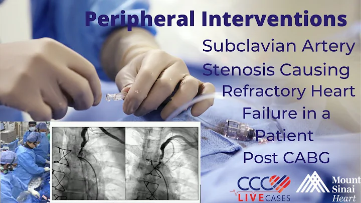 Subclavian Artery Stenosis Causing Refractory Heart Failure in a Patient Post CABG