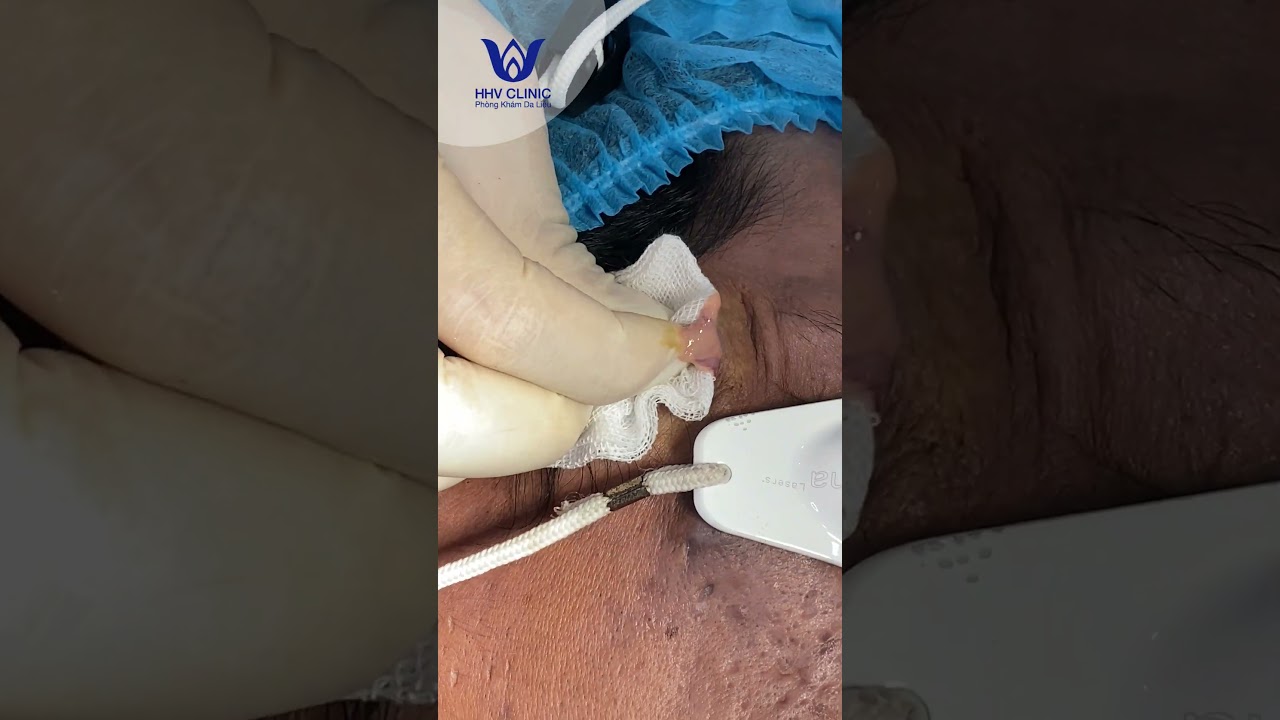 Nặn mụn mủ sưng viêm to.