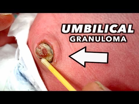 Video: Krūties Granuloma - Pieno Liaukos Ir Bambos Granulomų Priežastys, Diagnozė Ir Gydymas