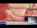 New treatment for enlarged prostates