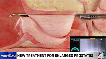 New treatment for enlarged prostates