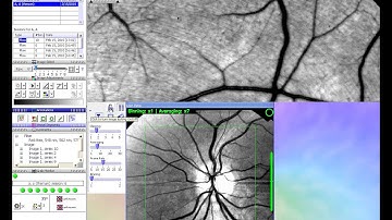 LVD    Retinal Tracking Demonstration