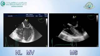 005 Mitral Stenosis TEE KAMC