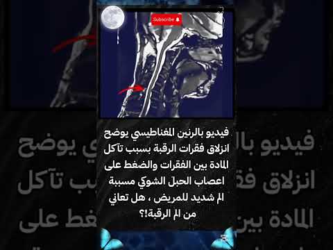 فيديو بالرنين المغناطيسي يوضح انزلاق فقرات الرقبة معلومات
