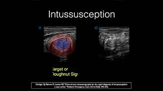 GI Tract Ultrasound in Pediatric Emergency Medicine Applications-SAMPLE Intussusception Ultrasound