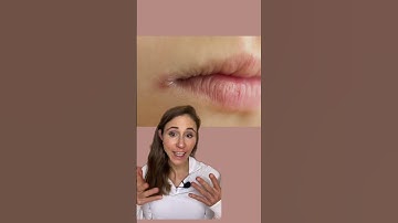 How To Get Rid Of Angular Cheilitis For Good! #dermatologist