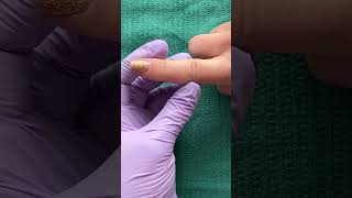 Finger Reduction