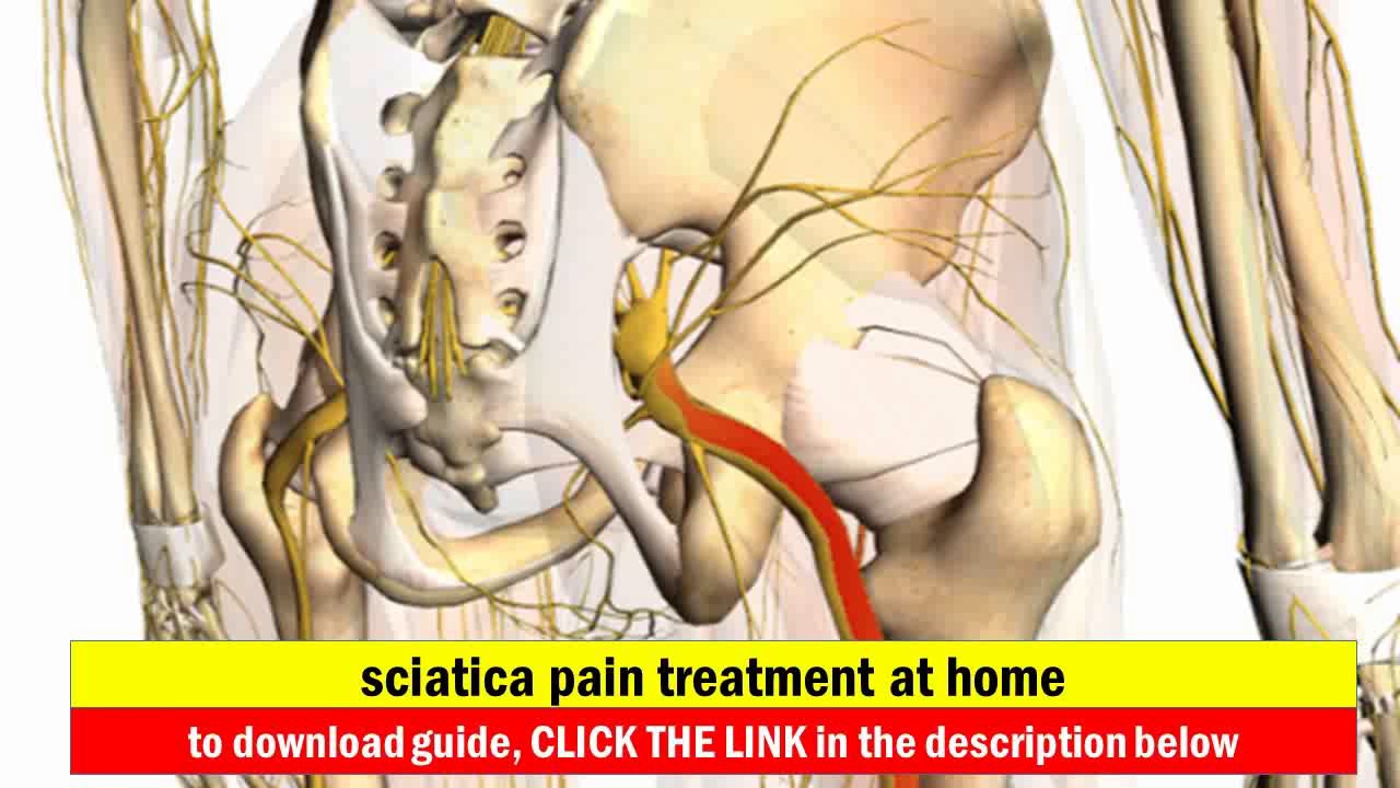 Симптомы боли седалищного нерва у мужчин. Ишиас - защемление седалищного нерва. Крестцовое сплетение седалищный нерв. Защемление седалищного нерва s1.