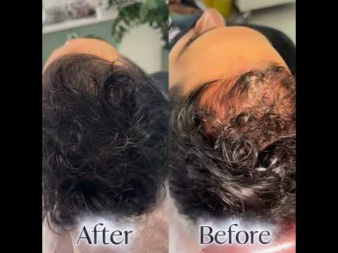 وقتی از تاثیر درمان ریزش موی ژنتیکی میگیم فقط در ۳جلسه